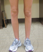 One or both legs turn out when standing