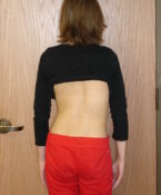 Curvature of the Spine