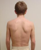 Uneven shoulder height