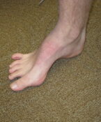 Flat feet or high arches