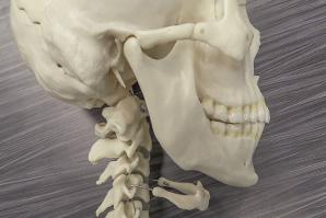 occlusal-cervical-restoration